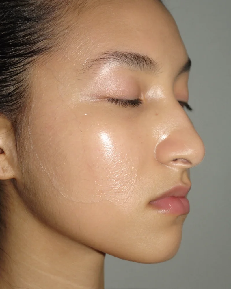 Skin after chemical peel