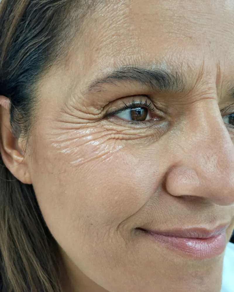 Eye area before botox