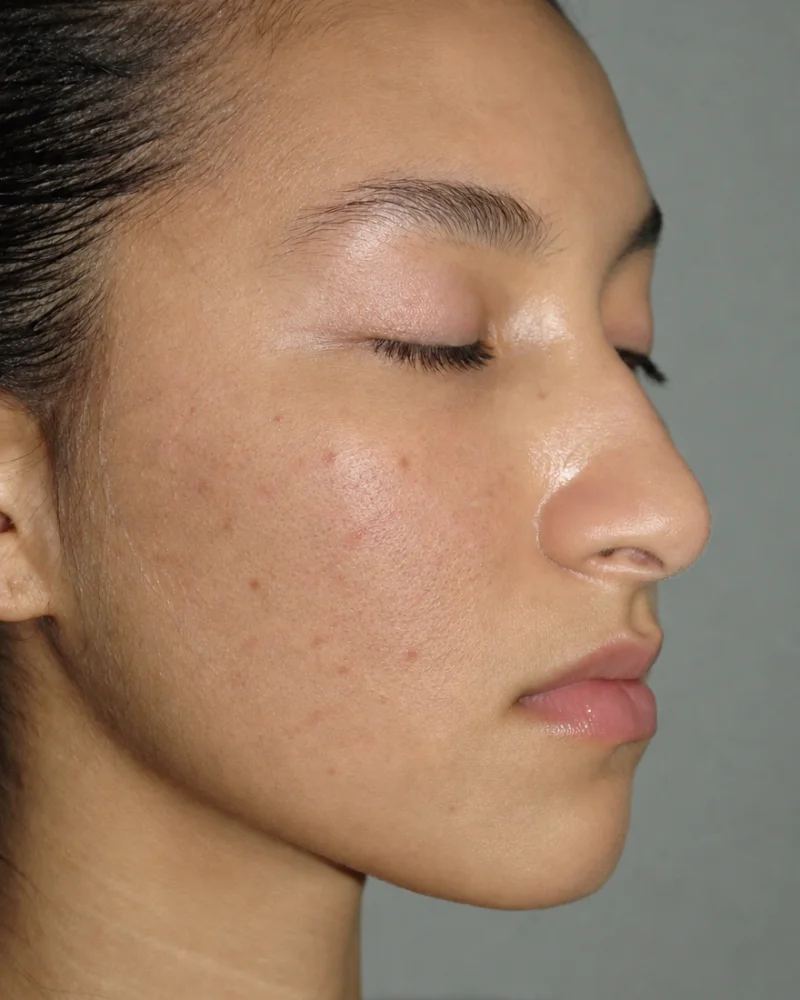 Skin before chemical peel