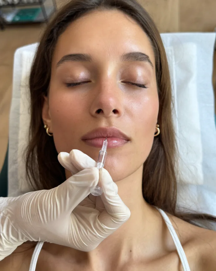 Lip filler with hyaluronic acid